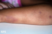 glanzmann's thrombasthenia
