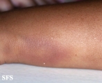 glanzmann's thrombasthenia