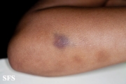 glanzmann's thrombasthenia