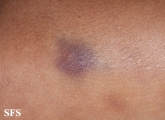 glanzmann's thrombasthenia