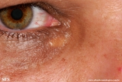 xanthelasma palpebrarum