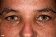 xanthelasma palpebrarum