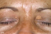 xanthelasma palpebrarum