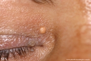 xanthelasma palpebrarum