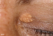 xanthelasma palpebrarum