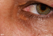 xanthelasma palpebrarum
