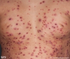 varicella