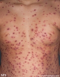 varicella