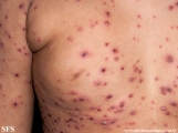 varicella