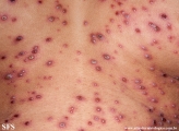 varicella