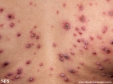 varicella