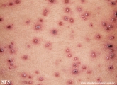 varicella