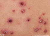 varicella