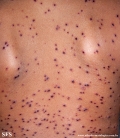 varicella