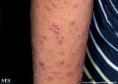 varicella