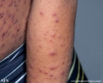 varicella