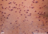 varicella