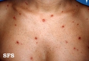 varicella