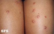 varicella
