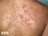 varicella