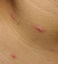 varicella