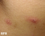varicella