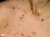 varicella