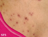 varicella
