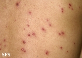 varicella