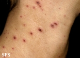 varicella