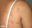 varicella