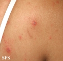 varicella