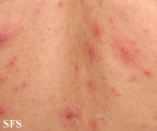 varicella