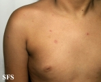 varicella