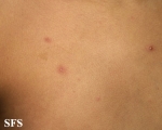 varicella