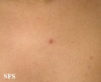 varicella