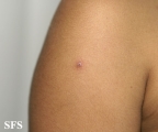 varicella
