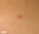 varicella