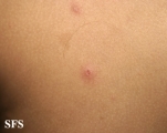 varicella