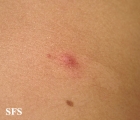 varicella