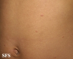 varicella