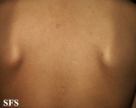 varicella