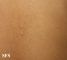 varicella
