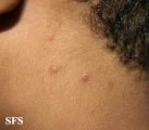 varicella