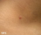 varicella