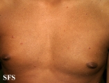 varicella