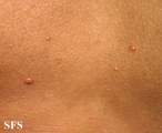 varicella
