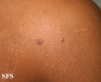 varicella