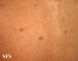 varicella