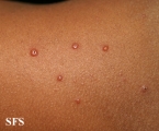 varicella